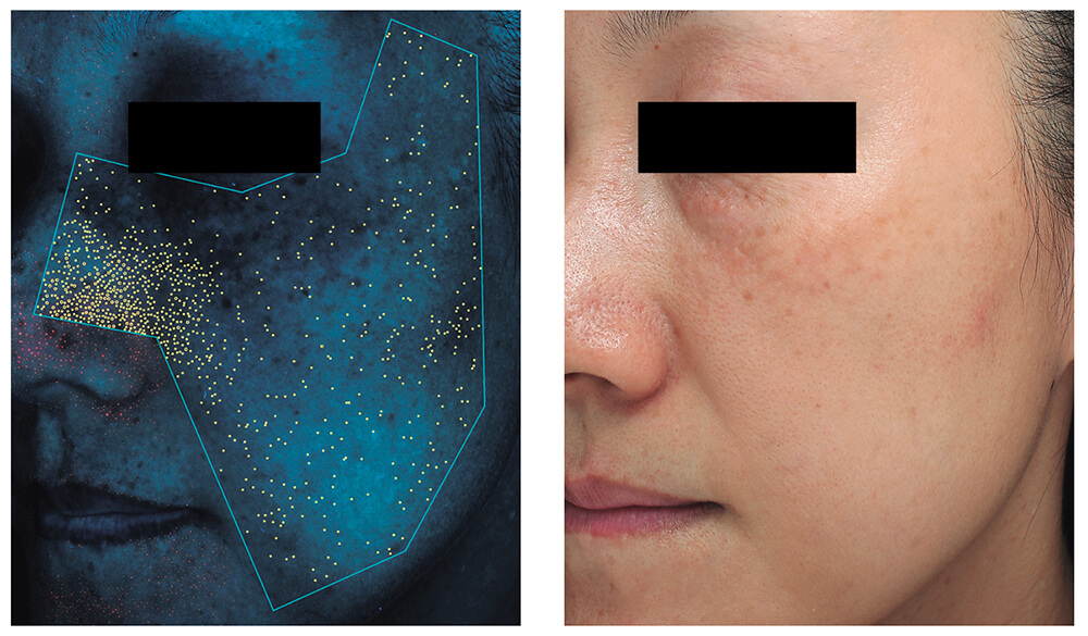 顔の一部分だけでお肌の状態は測れない！