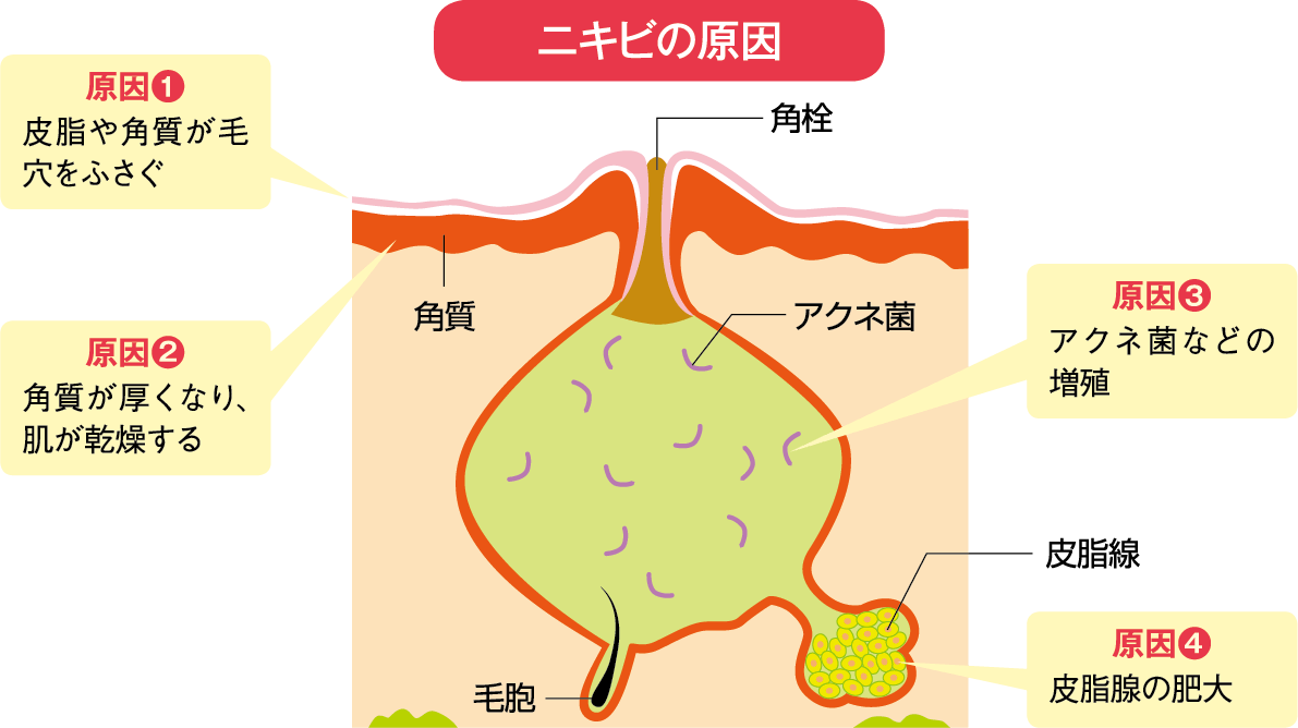 ニキビの原因