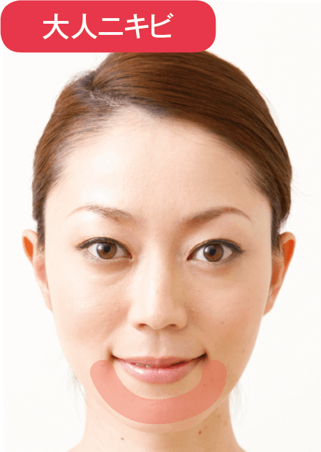 【大人ニキビ】